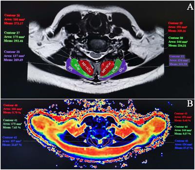 Correlation between degeneration of cervical intervertebral disc and degeneration of paravertebral muscle